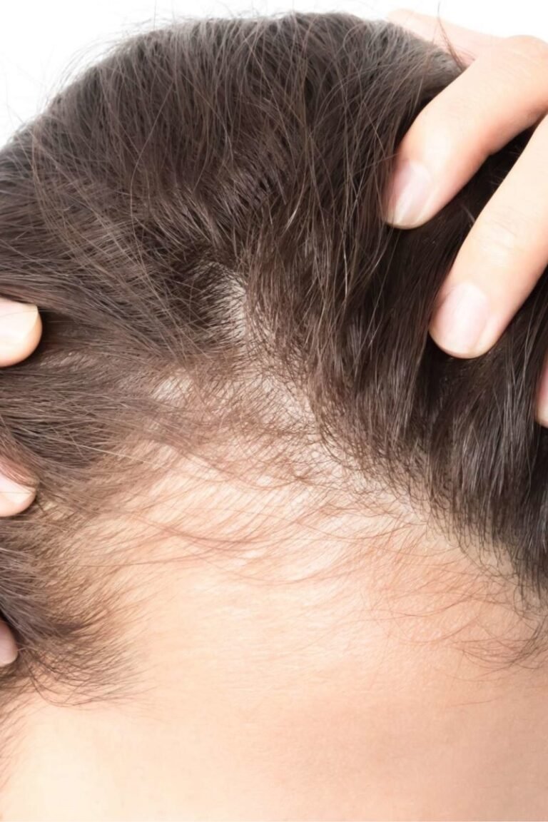 Homeopathy hair loss treatment an effective way to prevent hair fall